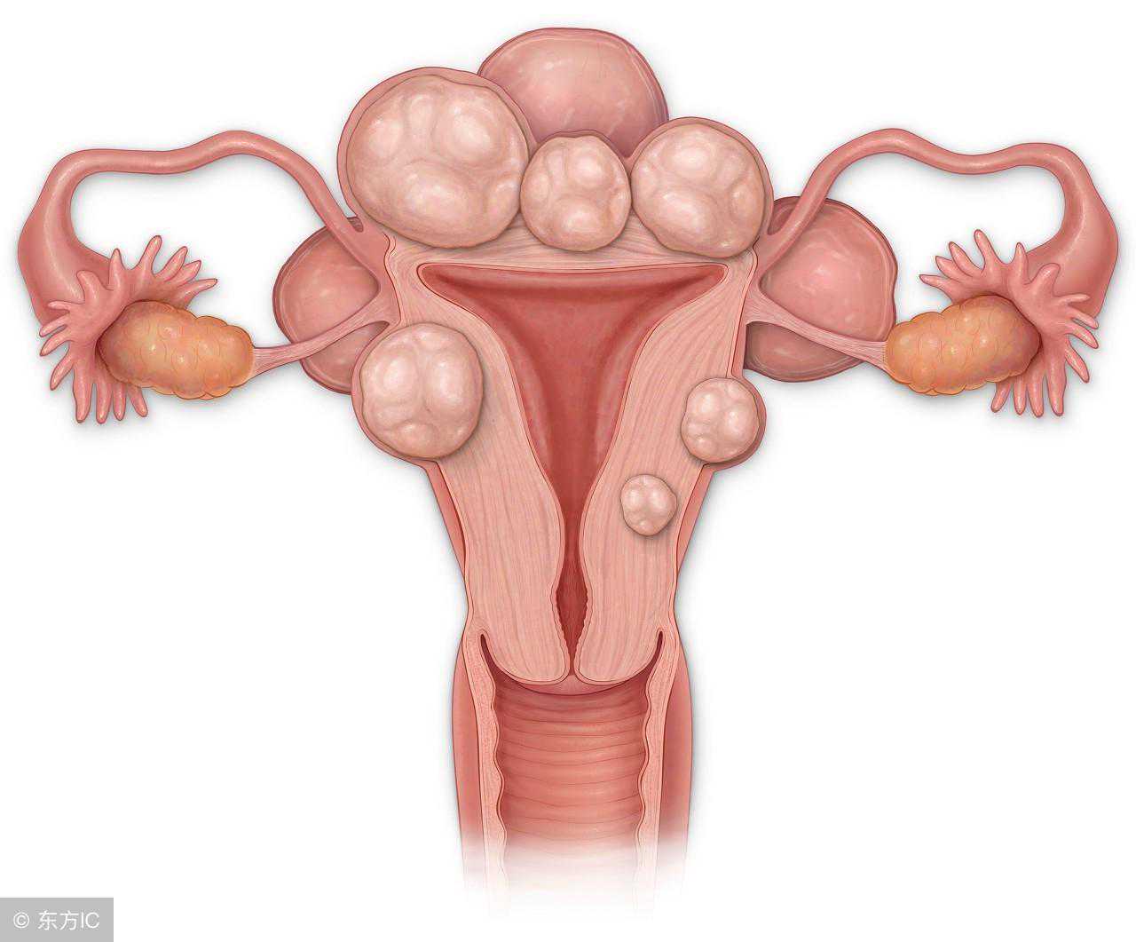 怀孕了，检查时发现子宫肌瘤，对胎儿有影响吗？